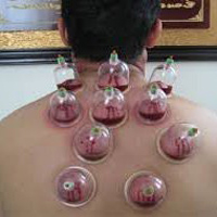 what is cupping