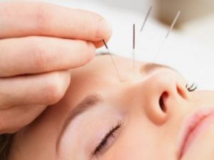 facial acupuncture for cosmetics
