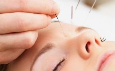 Cosmetics Facial acupuncture