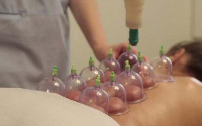 What is cupping and what does the process entail?